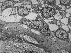 F,31y. | mucoepidermoid carcinoma